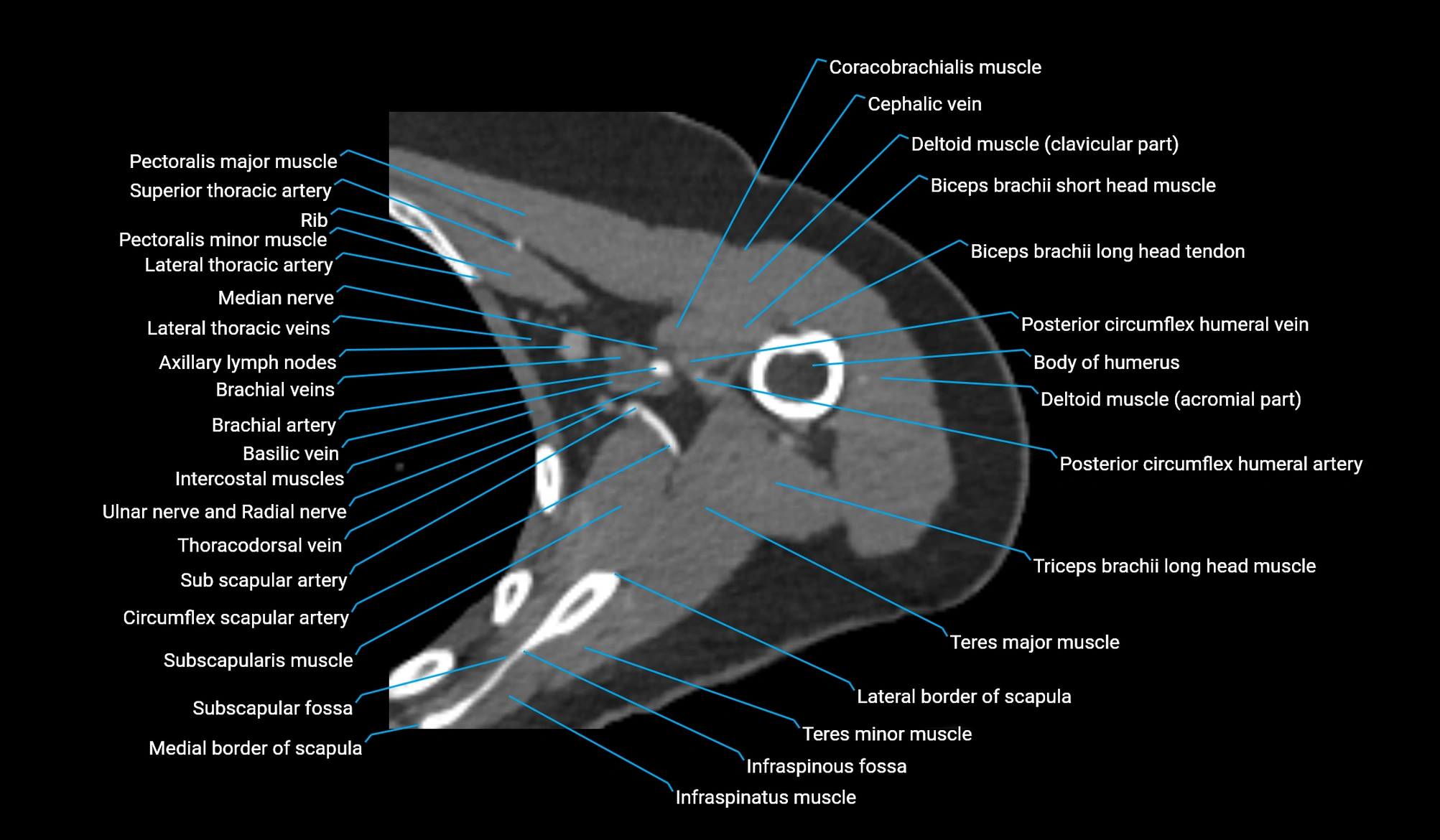 CT upper arm axial  cross sectional anatomy labelled radiology image -00134.webp